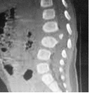 Bild von posterior hemivertebra in CT